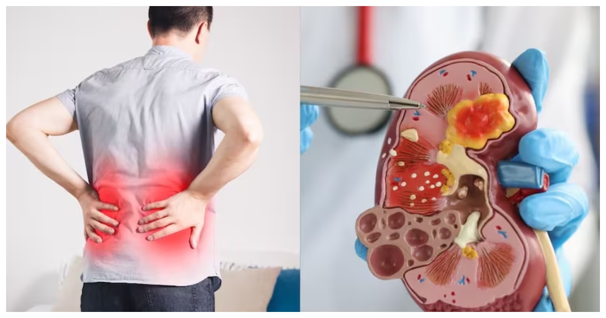 একটি কিডনির ওপর শরীর কাজ করলে উচ্চ  রক্তচাপের ঝুঁকি বেড়ে যায়। ছবি: টাইমস অফ ইন্ডিয়া